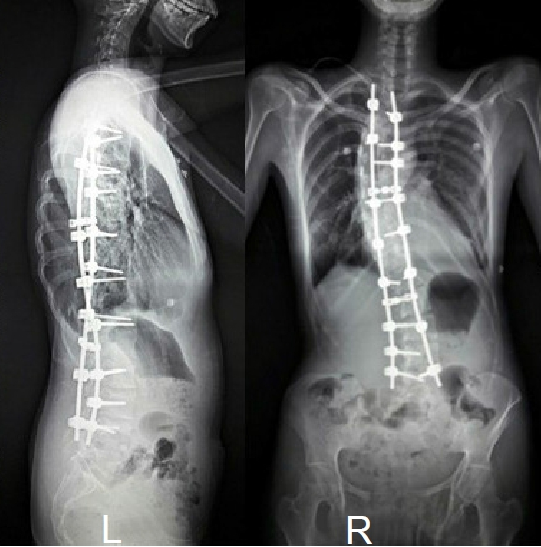 clinical picture showing the patient had a good functional outcome, and the AP and lateral x-ray postoperatively