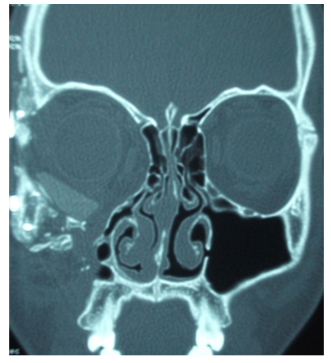 Computed tomography scan of facial bone demonstrated silastic sheet at right orbital floor