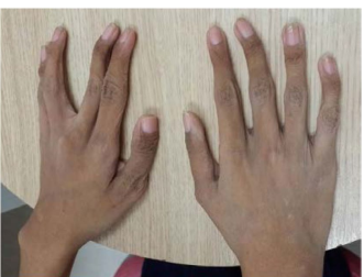 Characteristic abnormalities hypermobility of small hand joints