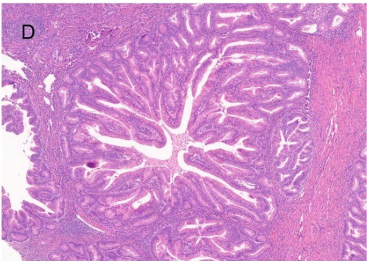 endometrial gastric-type adenocarcinoma characterized by complex glandular growth