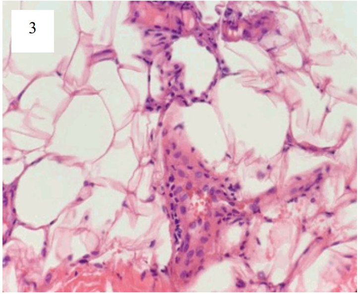 Histopathological examination of a skin biopsy 
